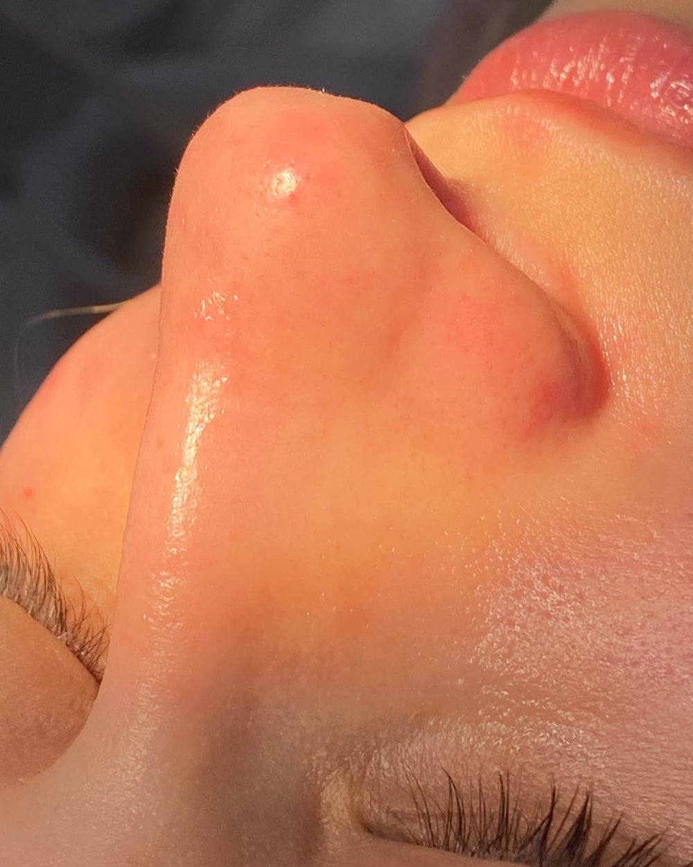 Resultado de limpeza de pele