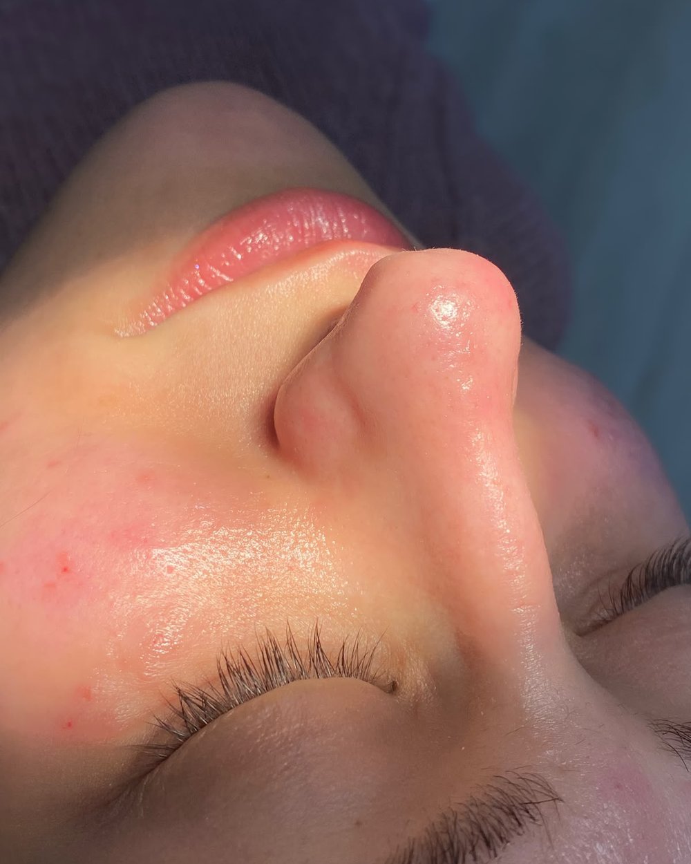 Resultado de limpeza de pele